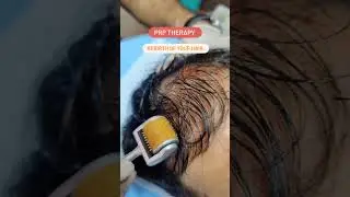 PRP Therapy in Jaipur #drvishalchugh #skincare #dermatologist #skindoctor #skincaredoctor