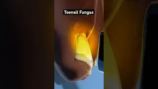 Eliminating persistent toenail fungus (3D Animation)