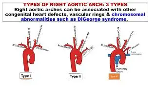 3b Congenital Anomalies of Aortic arches