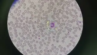 Immature Neutrophils| Band form Neutrophils
