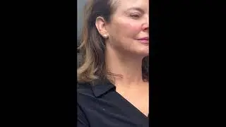 Sculptra: the longest lasting, natural filler with Dr. Janowski at Sonata