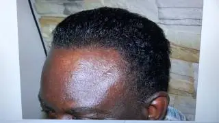 Black Receding Hair  Restoration Surgery Result 1 Year Follow Up Dr. Diep www.mhtaclinic.com