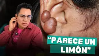 CICATRICES QUELOIDES POR PERFORACIONES I JAVIER DERMA