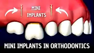 Mini Implants in Orthodontics