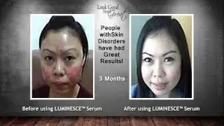 'Best Skincare For Acne'  Before and after pictures showing 'Best Skincare For Acne'