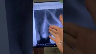Does a short fill cause endodontic failure? How about a long fill?