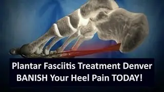 Best Plantar Fasciitis Treatment Denver - 303-974-4440 - Dr. Bradley Bosick D.C.