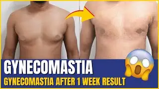 🙂Recovery after Gynecomastia Surgery | 1 week post op result