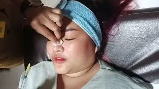 Filler with PRP for Nose