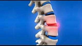 Chiropractor Omaha Explains if you Should Have Surgery for a Herniated Disc | Kinetic Chiropractic