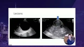 SAT 12 10 William Beaubien Souligny &ndash; Perioperative role of Renal Ultrasound