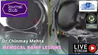Radiology Journal Club: Доктор Чинмей Мехта – Повреждения мениска