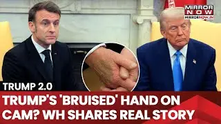 Mysterious Bruise On Trump's Hand Caught On Cam| Sparks Wild Theories| What's The Real Story?