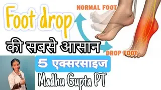 Foot Drop क्या है? Foot Drop की सबसे आसान 5 एक्सरसाइज|Madhu Gupta PT|#footdrop #omphysiotherapy 