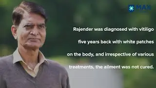 Narrowband UVB Light Therapy for Vitiligo │Patient Success Story │ Max Smart Saket