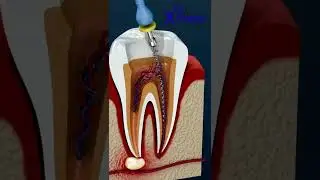 3D Root Canal Treatment | Painless Dental Care at Dr. Xpress #dentist #bangalore #smile #trending
