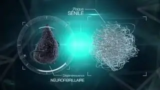 Qu'est ce qu la maladie d'Alzheimer