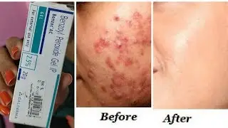 इससे होंगे पिंपल्स खत्म | Clear Acne Pimples once and for all - best solution for acne RabiaSkincare