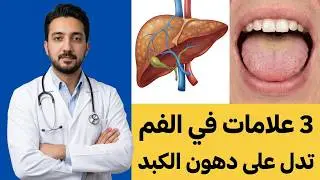 3 Symptoms of Fatty Liver Disease That Appear in the Mouth