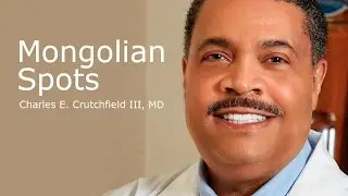 Mongolian Spots