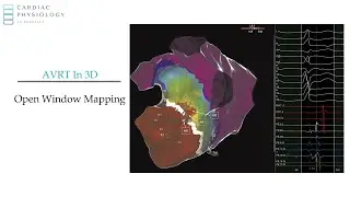 Open Window Mapping for AVRT - EP in Practice sample