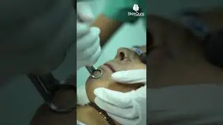 Best Carbon Peel Treatment in Delhi SkinQure | Dr. Jangid