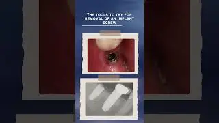 The tools to try for removal of an implant screw...