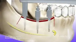 PIEZOSURGERY&reg; MECTRON Ridge split technique animation.