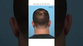Before & After 3 sessions of PRP Therapy