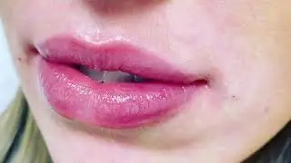 Lip Fillers Harley Street London