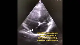 Малые аномалии сердца. Аневризма МПП.