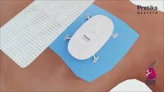 Pretika medtech Medical device animation