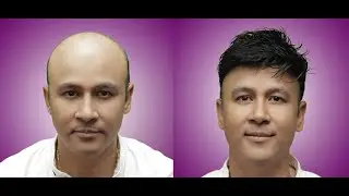Hair Replacement–Hair System-Hair Fixing-Hair Patch in Nepal | Lead Hair Replacement