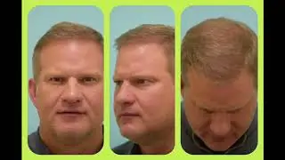 Dallas Megasession Hair Transplant Video Transformation