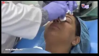 على المباشر..خاصية مثيرة ورائعة لعملية التقشير الكيميائي 