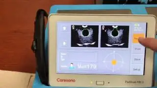 Caresono Padscan HD3 Bladder Scanner