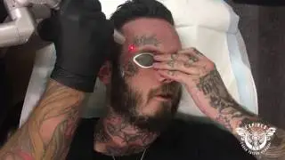FACE TATTOO REMOVAL | EXPIRED LASER STUDIO