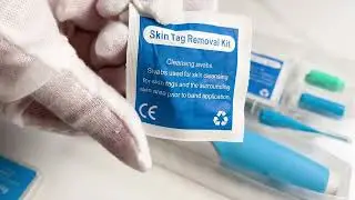 2 In1 Painless Auto Skin Tag Mole Wart Removal Kit Cleaning