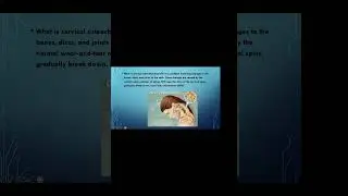63. Pectoralis minor syndrome.