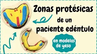 Zonas prot&eacute;sicas de un paciente ed&eacute;ntulo | pr&oacute;tesis total
