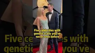 Five celebrities with genetic traits you&rsquo;ve never seen before #celebrity #news #billieeilish