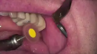 Dialite LD Feather Lite Intra-Oral Polishers