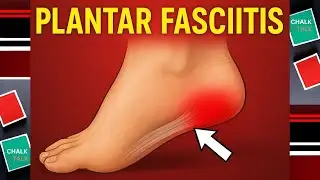 PLANTAR FASCIITIS - (HEEL PAIN)