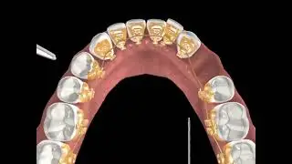 Incognito&trade; Appliance System Clinical Guide 08: Chicane Elastics