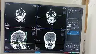 CT Scan Of Brain MPR Axial Printing 