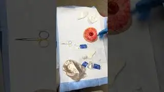 Ostomy Pouch Change with Crusting