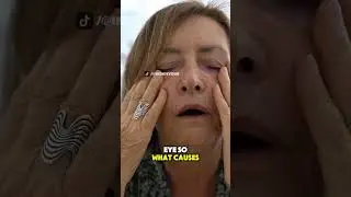 Brain Surgery for Face Pain &ndash; Trigeminal Neuralgia Explained in 3D #trigeminalneuralgia #facialnerve