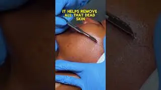Is Dermaplaning Safe for All Skin Types? Dermatologist Explains #beauty #dermaplaning #skincare