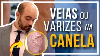 🔴 Veias ou Varizes na CANELA [O que causa? Pode ser normal?]