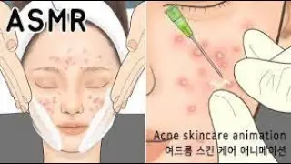 How do pimples form animation? Acne Removal Aimation....[ASMR]